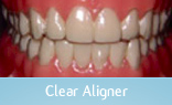 Clear Aligners