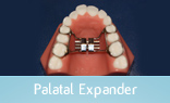 Palatal Expander