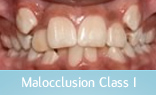 Malocclusion Class 1