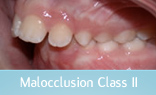 Malocclusion Class 1