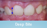 Malocclusion Class 1