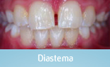 Malocclusion Class 1