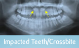 Malocclusion Class 1