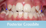 Malocclusion Class 1