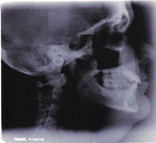 Cephalogram X-Ray