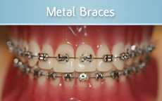 Metal Braces